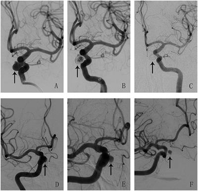 Safety and Efficacy of Coils in Conjunction With the Pipeline Flex Embolization Device for the Treatment of Cerebral Aneurysms